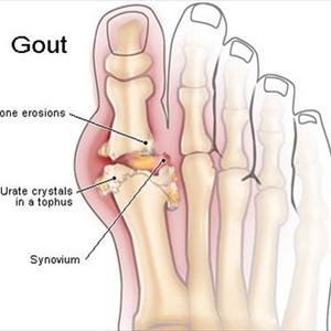 Causes Of Gout Of The Knee - Gout Treatment Medicines Or Drugs And Their Side Effects