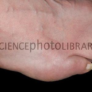 Dissolving Tophi - Cure Gout Symptoms With Home Remedy For Gout