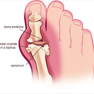 Lowering Uric Acid Level - Natural Treatments Regarding Gout