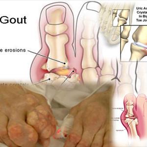 Food That Lower Uric Acid Levels - Some Home Based Treatments To Remove Gout