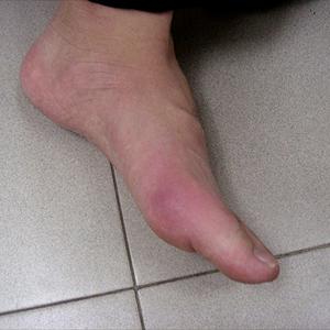 Can High Uric Acid Levels Cause Itching - Around Gout Irritation