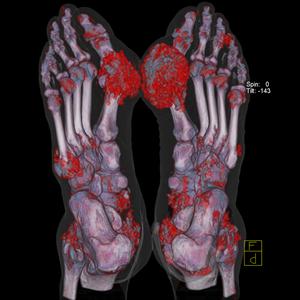 What Vegetable Helps To Reduce Uric Acid - Arthritis Treatment: The Four Crucial Important Factors To Maximum Gout Osteoarthritis Treatment