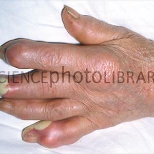 Asparagus For Gout Treatment - Gout Symptoms And Some Great Herbal Medicines For Gout