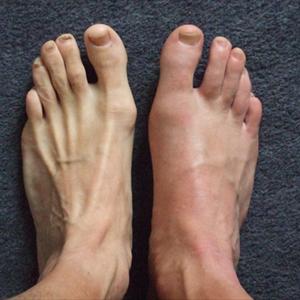 The Gout Remedy Report - In The Following Paragraphs We