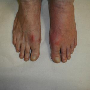 Tdbs - The Method To Ease Gout Pain?