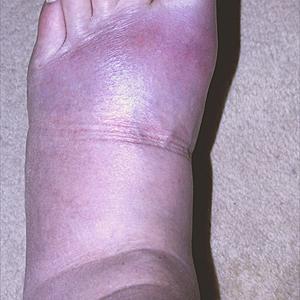 Dissolving Uric Acid - Gout Diet Guidelines That Work