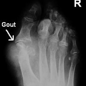 Can Cocaine Cause Gout - The Argument About Treatment For Gout