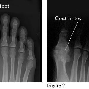 What Vegetables Are Bad For Gout - Foods For Gout