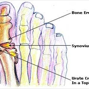 Poultice Uric Acid Crystals - What To Do When Your Feet Is Swollen As A Result Of Gout