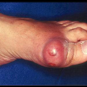 Cure For Gout - Naturally Remedy Gout Fast - Follow These Development Methods Now