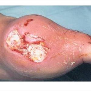 Poultice Uric Acid Crystals - What To Do When Your Foot Is Swollen Because Of Gout