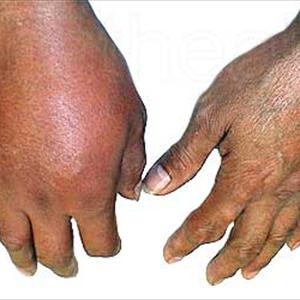 Is Coffee Bad For Gout - Symptoms Of Gout - The Actual Repeated Warning Signs Of Gout