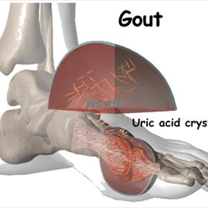 Fluids To Avoid With Gout - Ascorbic Acid A Possible Cure Intended For Gout