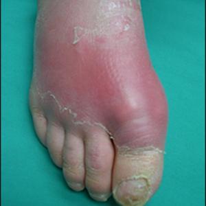 Purine Lowering Diet - What Are The Foods To Avoid For Gout Sufferers?