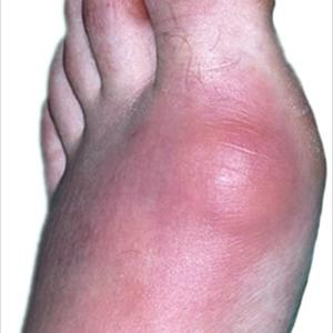 Orange Juice Doubles Risk Of Gout - Gout Treatment Medications Or Drugs And Their Facet Effects