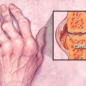 Allopurinol Alcohol - Gout Treatment Medicines Or Drugs And Their Side Effects