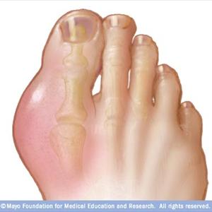 Allopurinol And Alcohol Use - Do You Think Apple Cider Vinegar Treatment Is The Perfect Solution Regarding Gout?