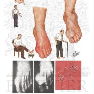 Is High Uric Acid Hereditary - Cure For Gout That Will Work - Follow These Tips